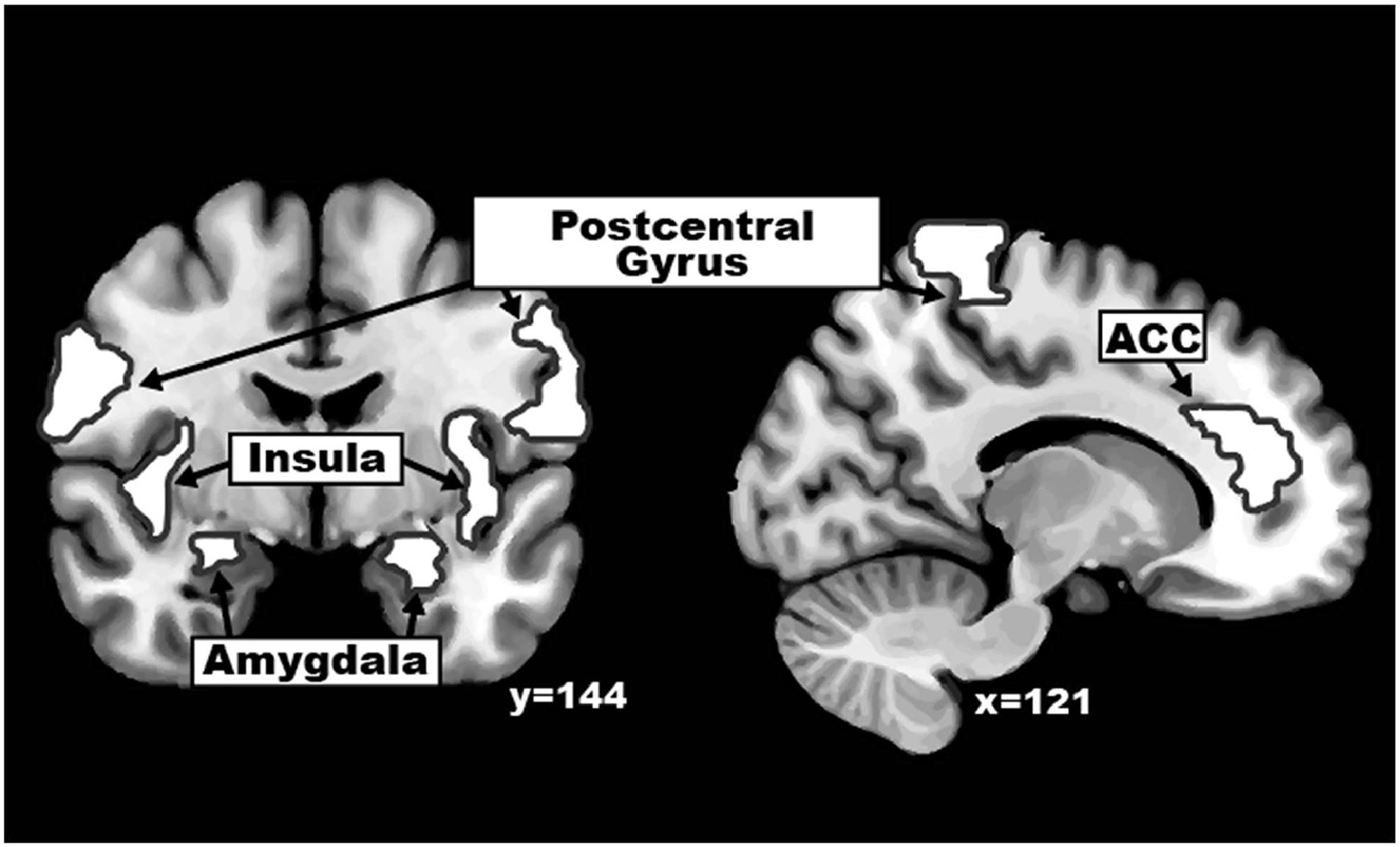 Anatomical regions of interest (Amygdala, Insular Cortex, Anterior&amp;nbsp;Cingulate Cortex (ACC), and Postcentral Gyrus).