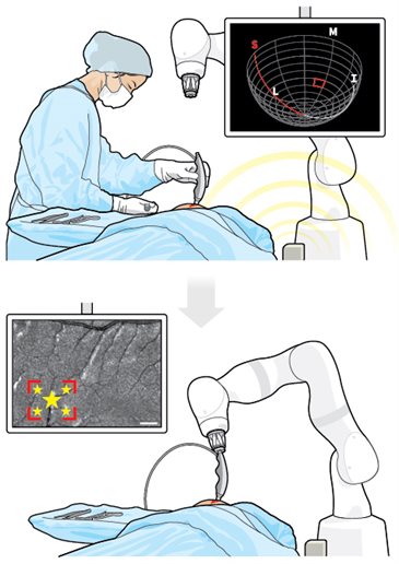 A two part figure showing the MarginDx system. 1. a surgeon holding a probe scans a tumor cavity. 2. the probe is shown mounted to a robotic arm to scan and classify tissue within the tumor cavity using AI.